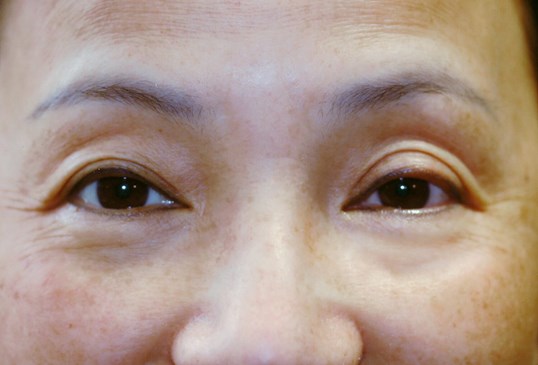 results of drop n lift at sightmd