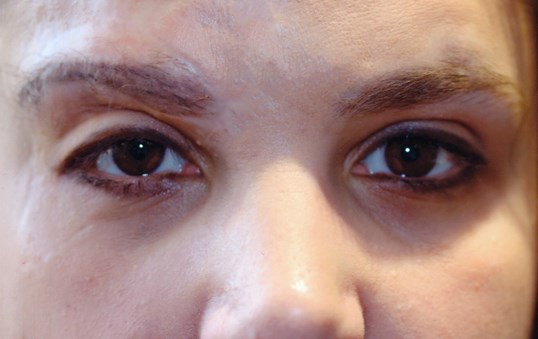 results of drop n' lift procedure on middle aged female patient at sight md