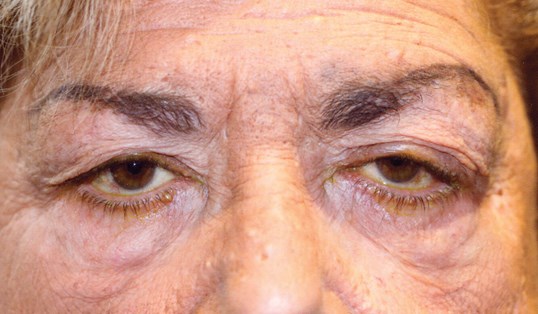 older male patients eyes before drop n' lift procedure