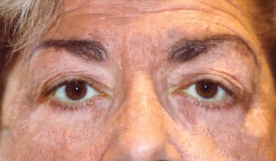 results of drop n' lift surgery on male patient at sight md