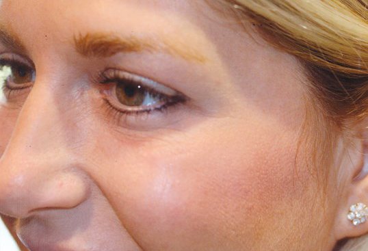 results of botox injections on a female patient