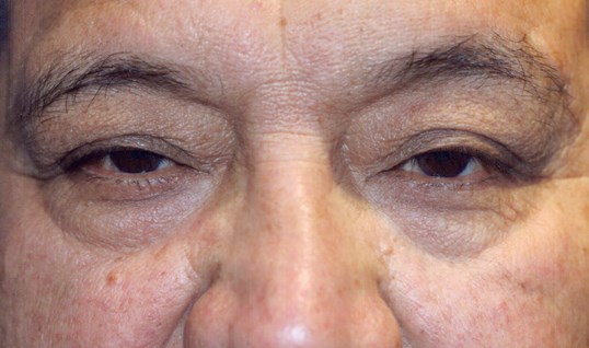 patients eyes close up before drop n' lift surgery