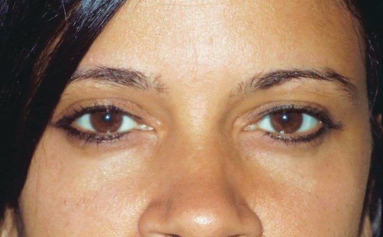 results of drop n' lift procedure at sightmd