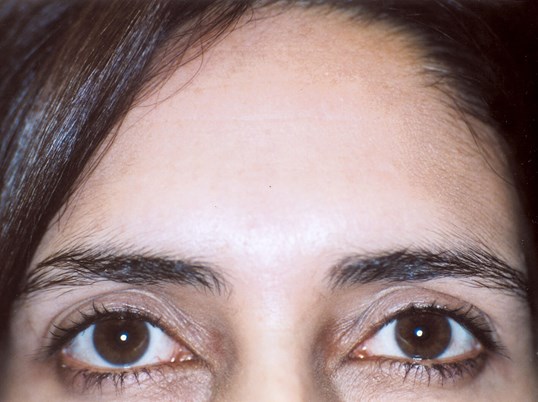 womans forehead before and after injections of botox