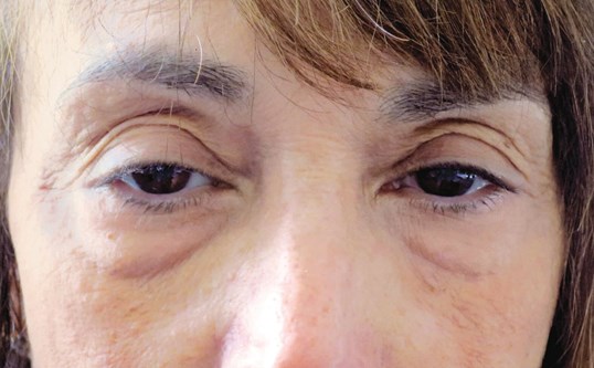 eyes before female drop n' lift procedure at sightmd