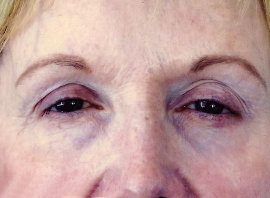older female patient before drop n lift procedure at sight md