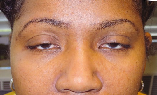 female with eyes partially closed before drop n' lift surgery