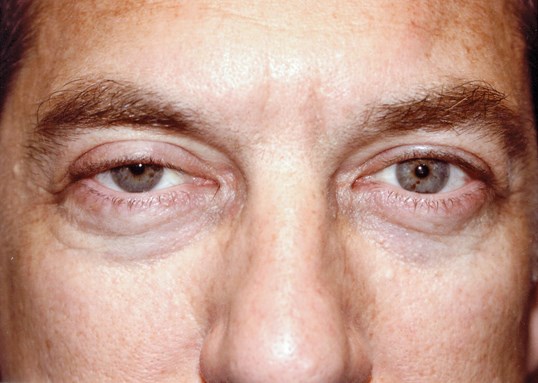male patient one eye partially closed before drop n' lift eye repair surgery