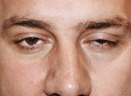 male one eye mostly closed before drop n' lift eye surgery