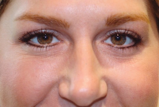 womans middle face following botox injectable procedure