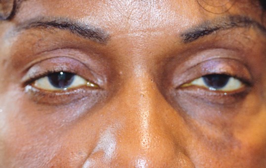 older female patients eyes before eye surgery drop n lift procedure