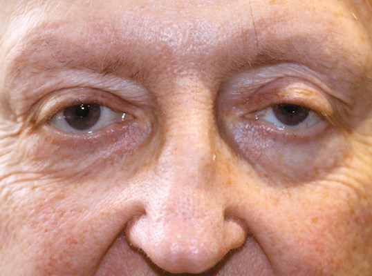 before surgery on older male patient drop n' lift at sightmd