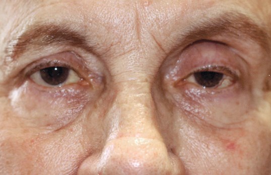sightmd before drop n' lift by dr. james gordon on older female patient