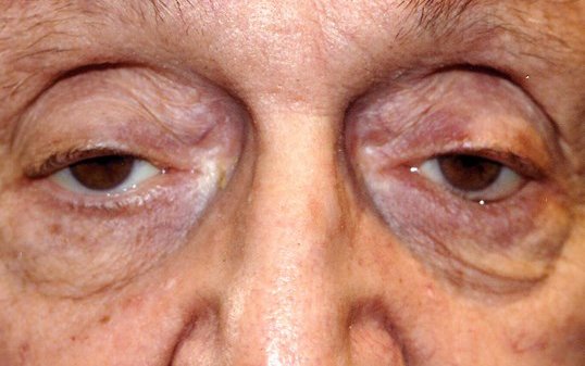 closeup of male patients eyes before undergoing drop n lift