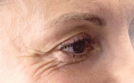 womans wrinkles around eyes before botox injectables