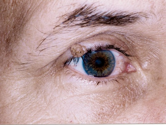 eyelid tumor on a female patient