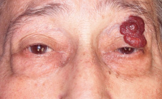large eyelid tumor on male patient