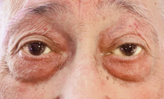 sightmd eyelid tumor removal results