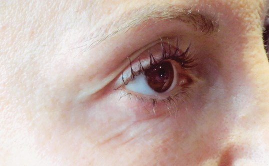 results of botox around the eyes