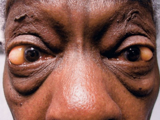 large eye tumors