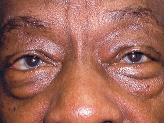 results of eyelid tumor removal at sightmd
