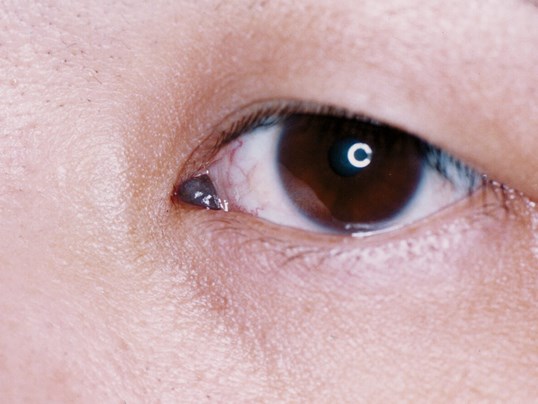 small eye tumor on corner of patients eye
