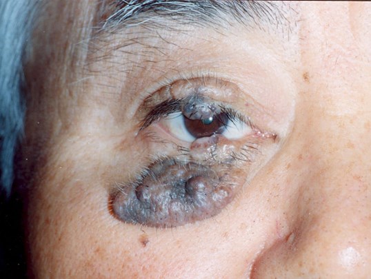 massive eye tumor on upper and lower eye