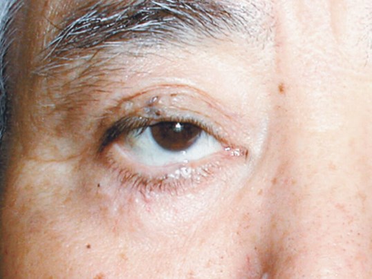 sightmd eyelid tumor removal results on patient