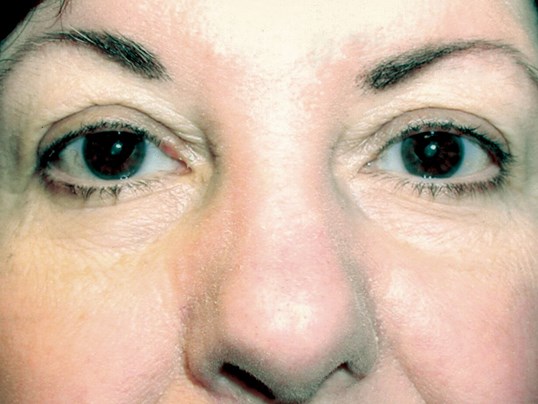 patient results after eyelid tumor removal