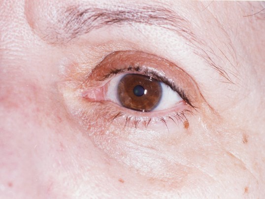 patient eye after eyelid tumor removal
