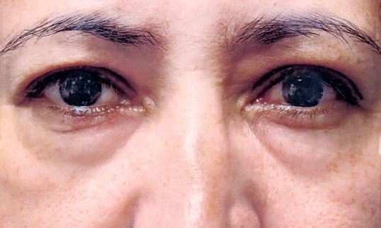 eyelid tumor removal by the doctors at sightmd