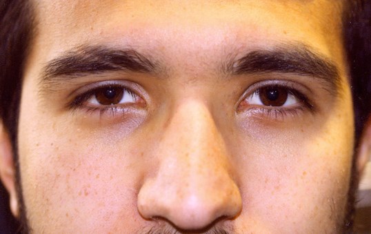 sightmd eyelid tumor removal procedure on male patient