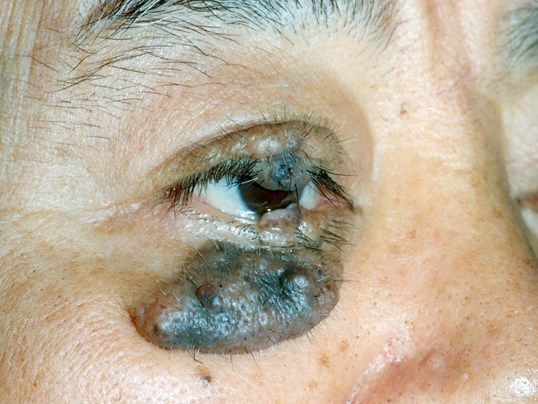 bump on eyelid of patients eye top and bottom