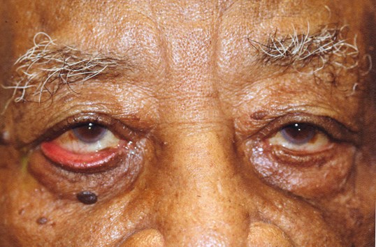 patient with small tumor on eyelids