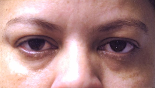 female patient eyelid reconstruction after skin cancer results
