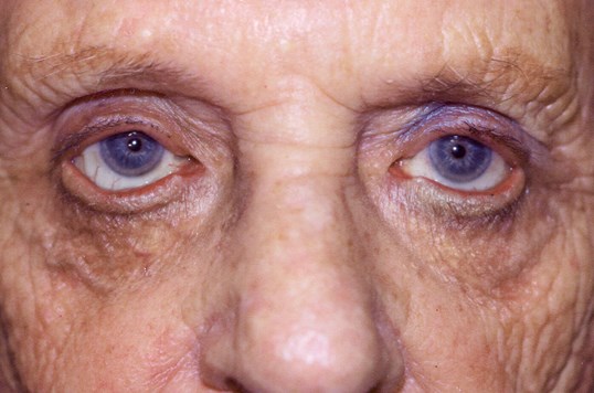 male patients eyes eyelid repair surgery