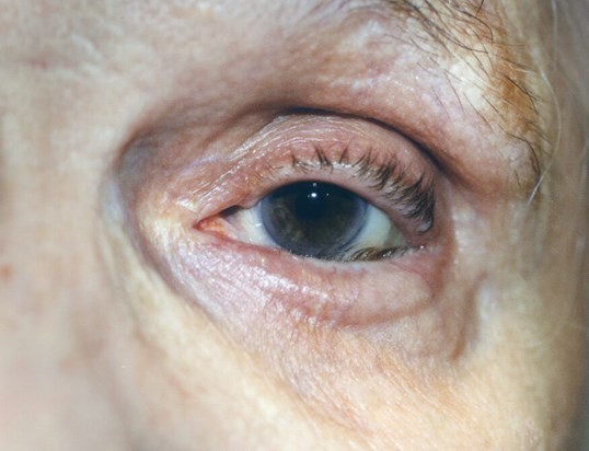 close up of female eye before eyelid repair surgery