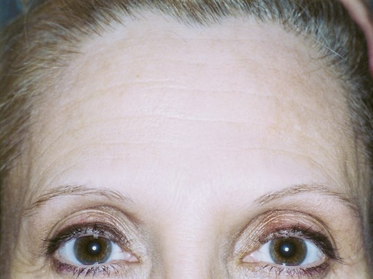 wrinkle lines on forehead of female patient