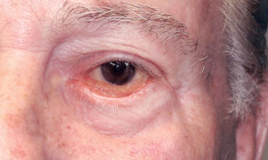 close up of male patients eye before eyelid repair surgery