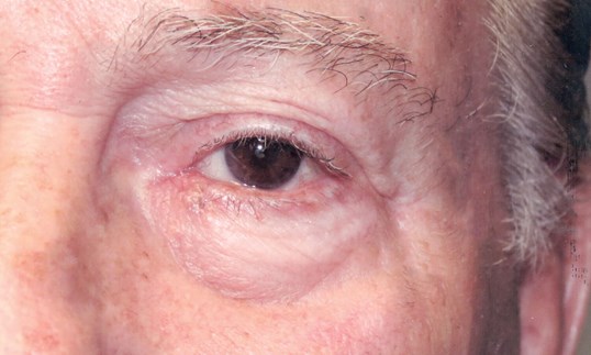 eyelid repair surgery on male with brown eyes