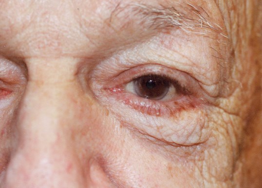 eyelid repair surgery on older female patient with brown eyes