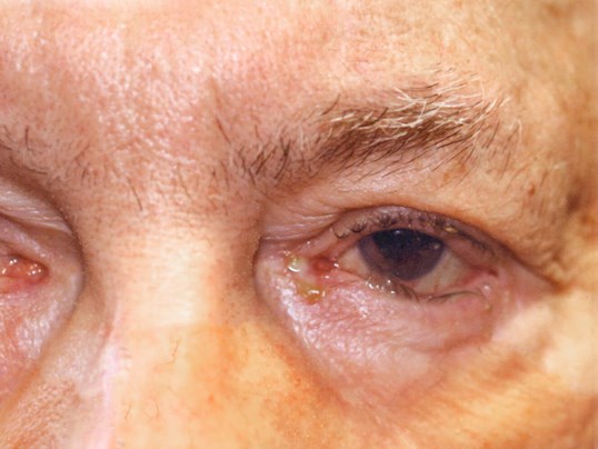 eyelid repair surgery on male eye closeup