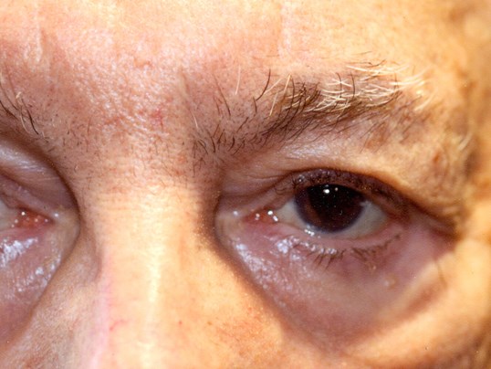close up of dark brown eye on patient receiving eyelid repair