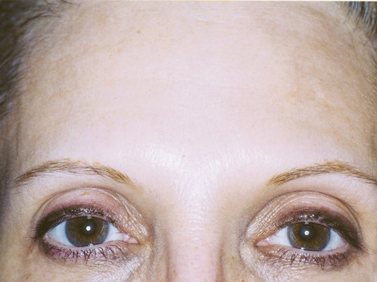 botox injections on the forehead results