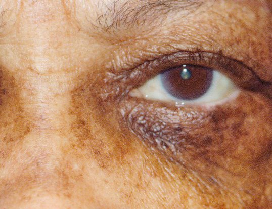 eyelid repair surgery on older female patient