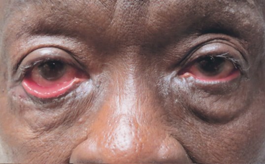 womans eyelids before eyelid repair surgery