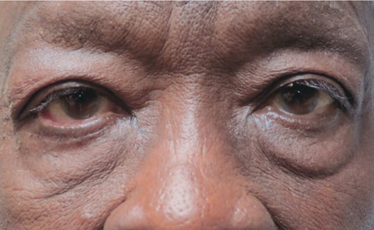 eyelid repair surgery at sightmd