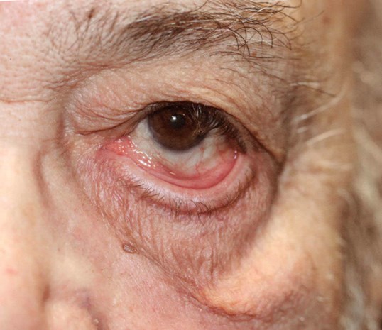 male eyelids before eyelid repair surgery