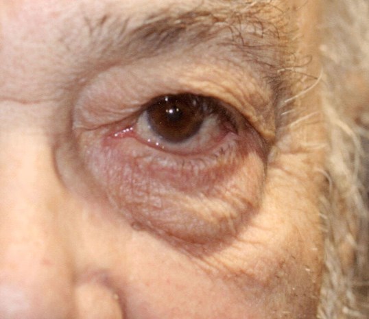 close up of womans brown eye undergoing eyelid repair surgery