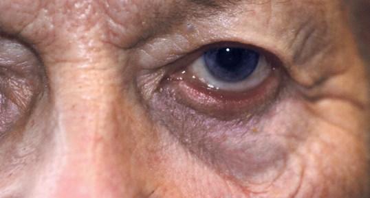 womans close up eyelids before eyelid repair surgery